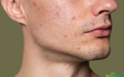 treat hidden acne at home