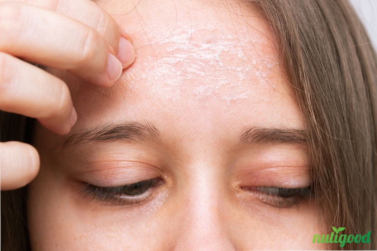 dry flaky skin on face